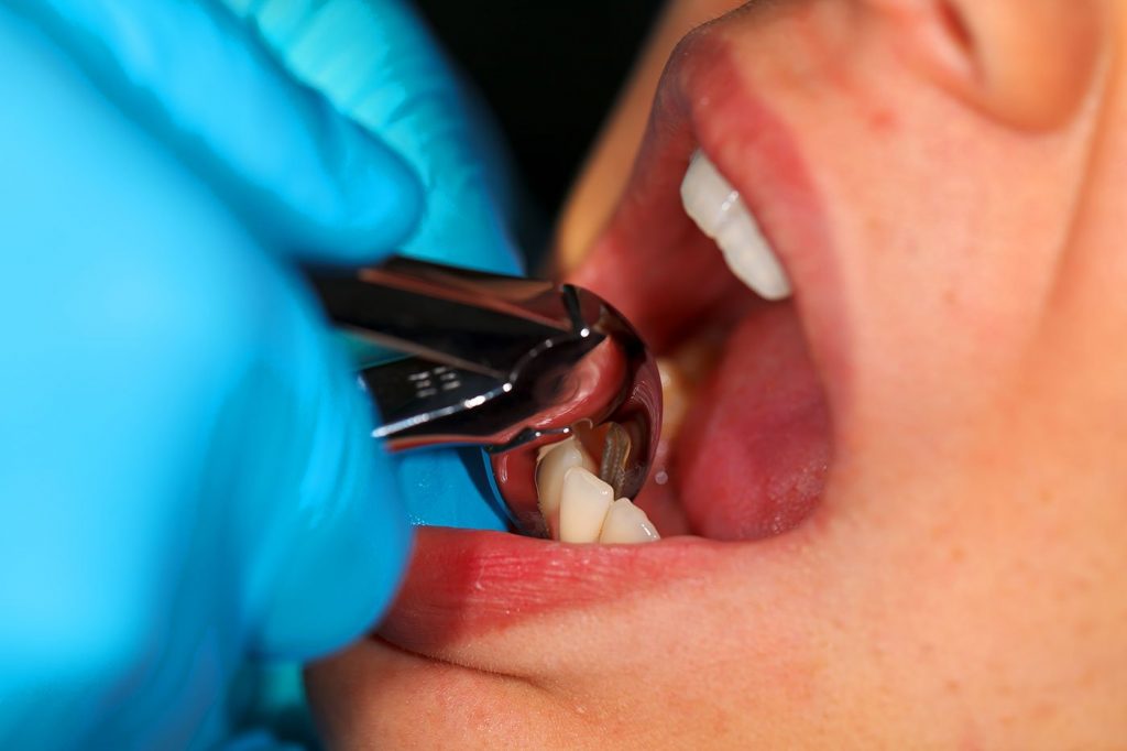 Extractions & Wisdom Tooth Removal in Mississauga