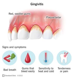 bleeding gums